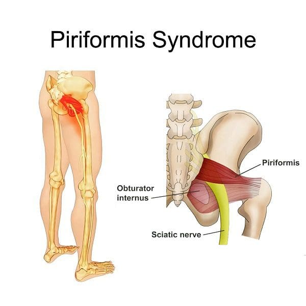 Piriformis syndrome 