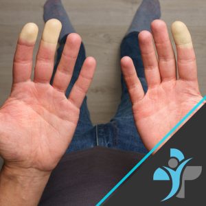 Raynaud's Disease