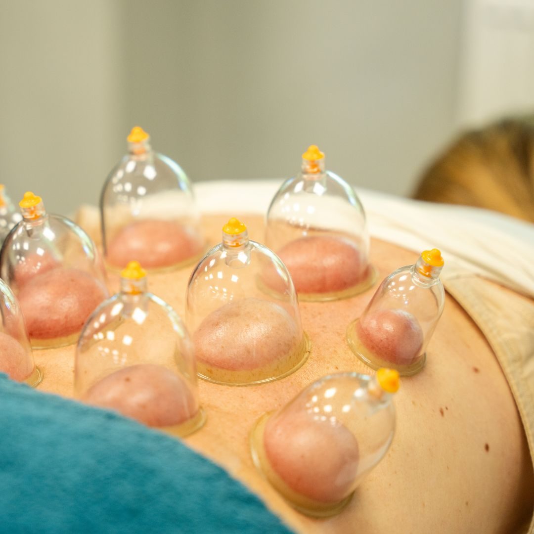 Cupping Services by LiveWell